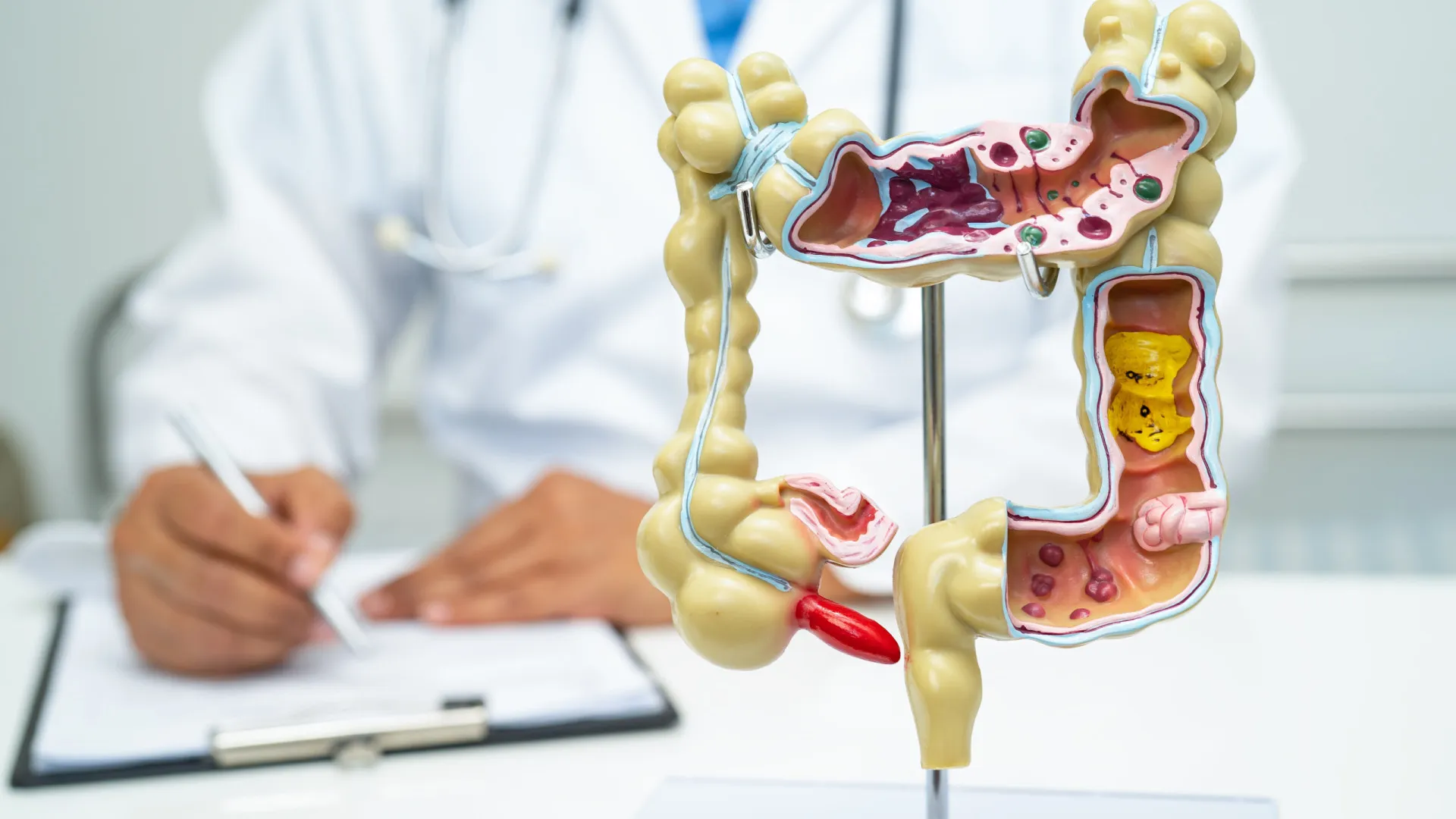 5 curiosidades que precisa saber sobre doenças inflamatórias intestinais
