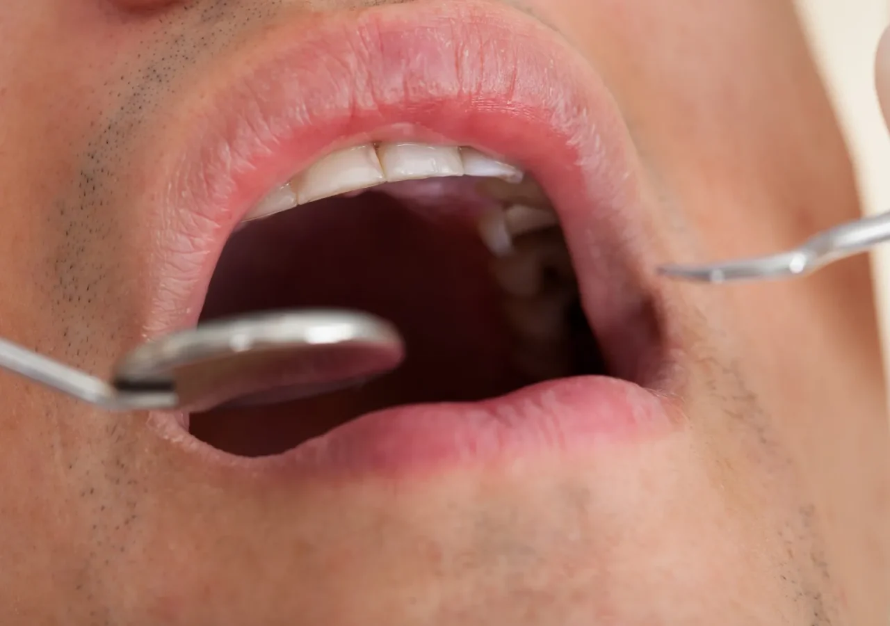 32% dos brasileiros não foram ao dentista no último ano